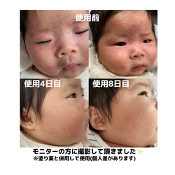 引っ掻き防止クッション　かきむしり防止　乳児湿疹　目を擦る　対策　赤ちゃん　ベビー　 7枚目の画像