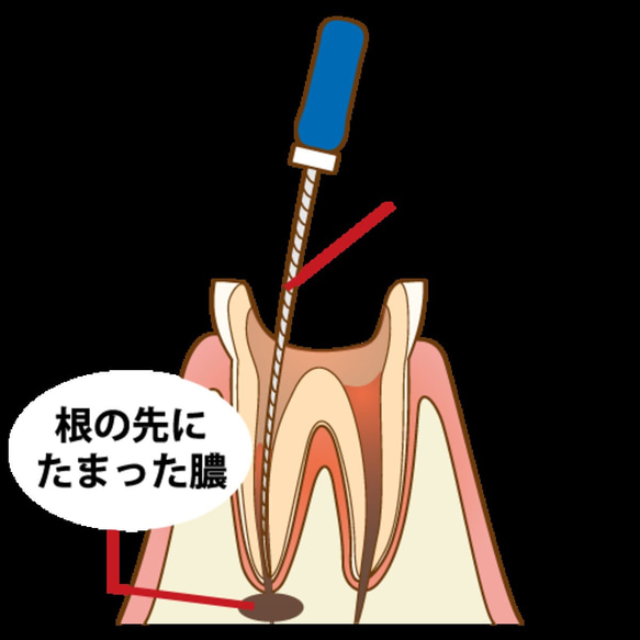 歯内治療リーマーストラップ 10枚目の画像