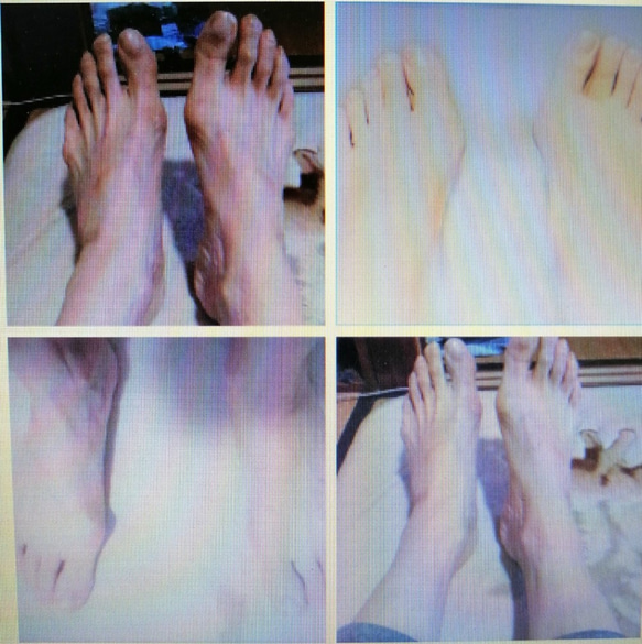 ◆付費 ◆拇囊炎支援 ◆腳背寬高 ◆開始為有顧慮者提供有償支援 ◆腳趾畸形 ◆拇趾囊炎 ◆左右不對稱 ◆腳跟調整 ◆ 第7張的照片